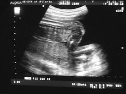 [Sonogram]